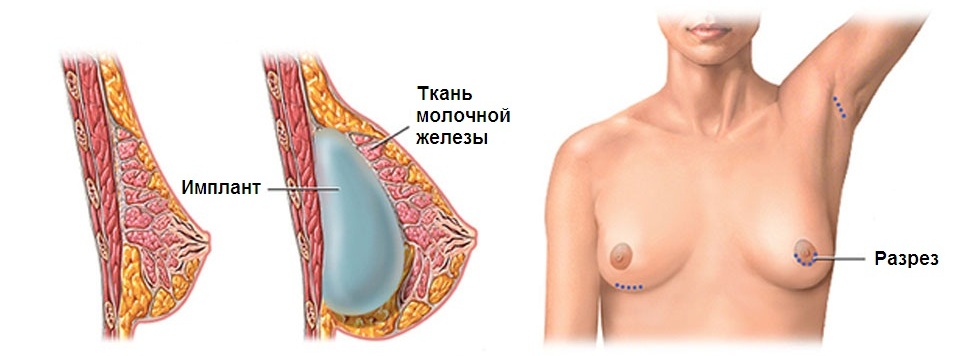 Операция по увеличению грудей - Маммопластика